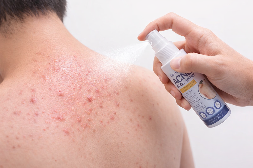 DERMAID Body Spray 50ml Gentle for Sensitive Skin with Salicylic Acid