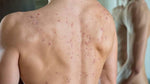 Oxecure Body Acne Spray 50ml - Debsline.co  -  