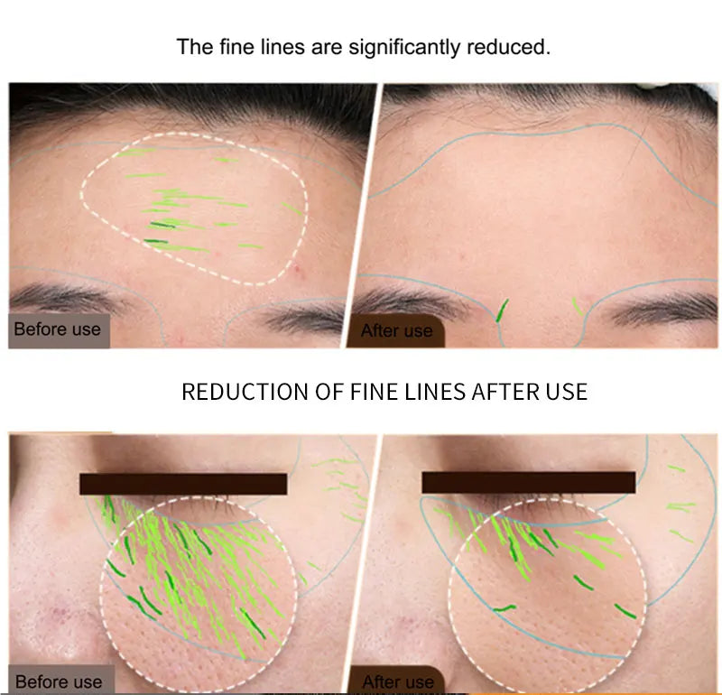 BEEMYI Professional EMS Facial Body RF Machine Skin Tightening Face Lifting Anti-Aging Home Beauty Device for Skin Care