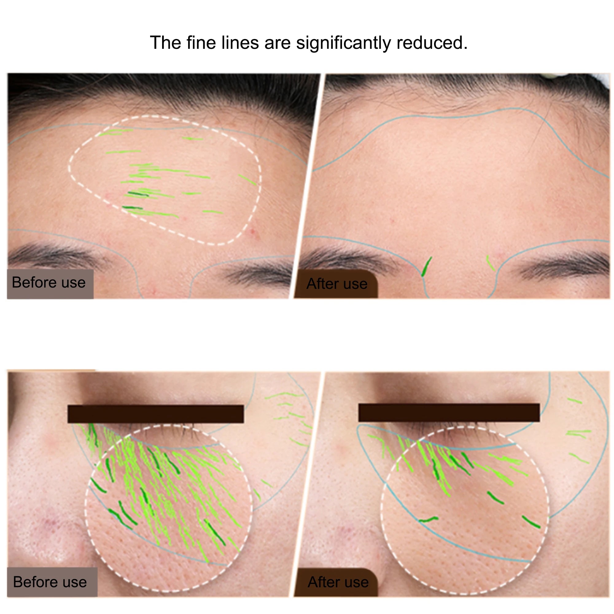 BEEMYI Professional EMS Facial Body RF Machine Skin Tightening Face Lifting Anti-Aging Home Beauty Device for Skin Care